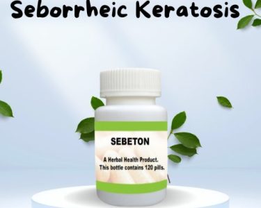 Naturally Treating Seborrheic Keratosis