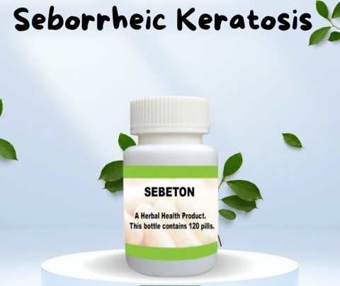 Naturally Treating Seborrheic Keratosis