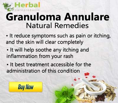 Treatment of Granuloma Annulare With Herbal Remedies