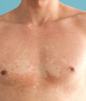 Patchy discoloration after sun exposure could be fungal infection, says Doctor
