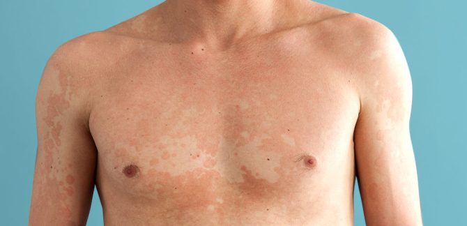 Patchy discoloration after sun exposure could be fungal infection, says Doctor