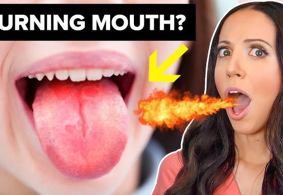 Burning Mouth Syndrome Relief How to Find Comfort and Calm Fast