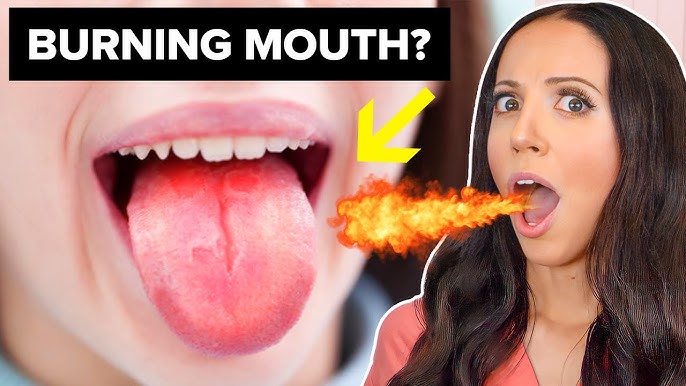 Burning Mouth Syndrome Relief: How to Find Comfort and Calm Fast