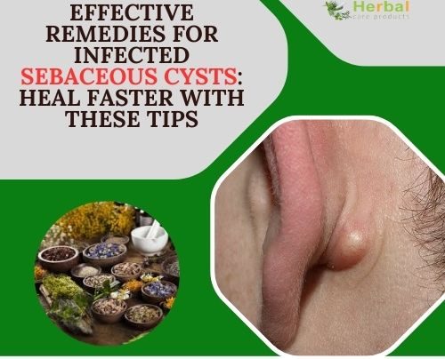 Effective Remedies for Infected Sebaceous Cysts