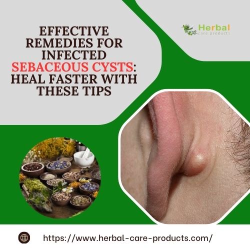 Effective Remedies for Infected Sebaceous Cysts: Heal Faster with These Tips