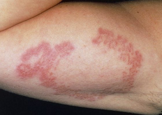 Granuloma Annulare Rash - Herbal Care Products