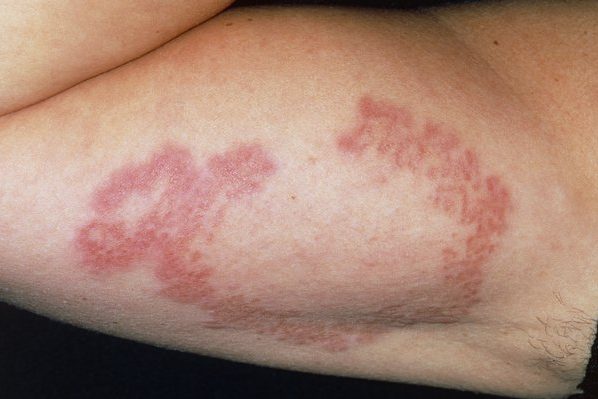 Granuloma Annulare Rash - Herbal Care Products