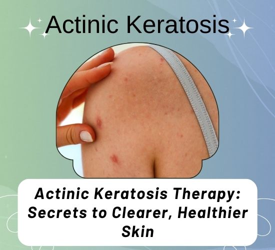 Actinic Keratosis Therapy: Secrets to Clearer, Healthier Skin