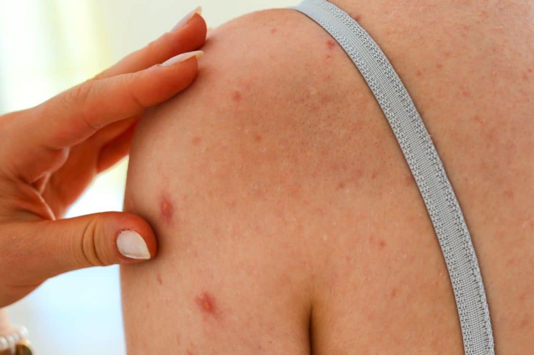 Actinic Keratosis Therapy: Secrets to Clearer, Healthier Skin