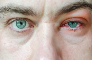 Blepharitis Alternative Treatments