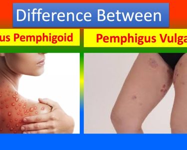 Bullous Pemphigoid and Pemphigus Vulgaris