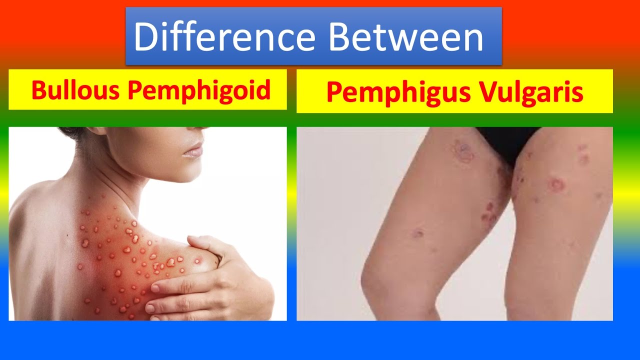 Bullous Pemphigoid vs Pemphigus Vulgaris: Treatment Options You Need to Know