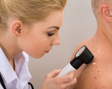 Laser Treatment for Actinic Keratosis