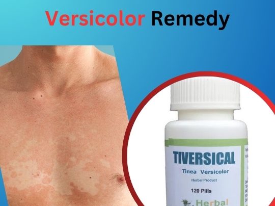 Natural Remedy for Tinea Versicolor