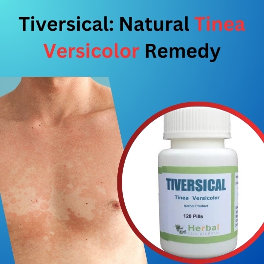 Tiversical: Natural Tinea Versicolor Remedy