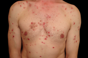 Pemphigus Vulgaris