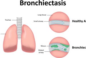 What is Bronchiectasis