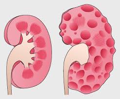 Adult Polycystic Kidney Disease