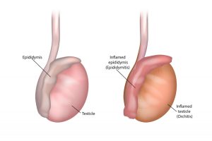 How Long Does It Take for Epididymitis to Heal 1