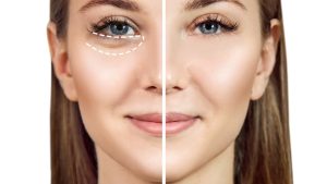 How to Get Rid of Eye Bags Permanently at Home 1