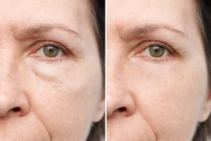 How to Get Rid of Eye Bags Permanently at Home 2