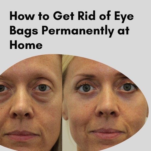 How to Get Rid of Eye Bags Permanently at Home: Your Complete Step-by-Step Guide