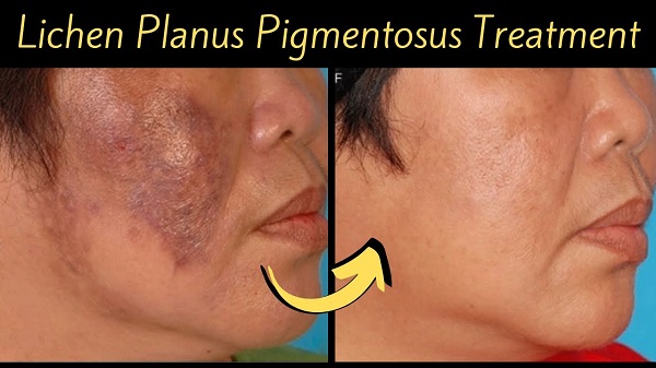 Living with Lichen Planus Pigmentosus: Expert Tips for Skin Care