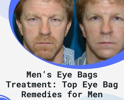 Men’s Eye Bags Treatment