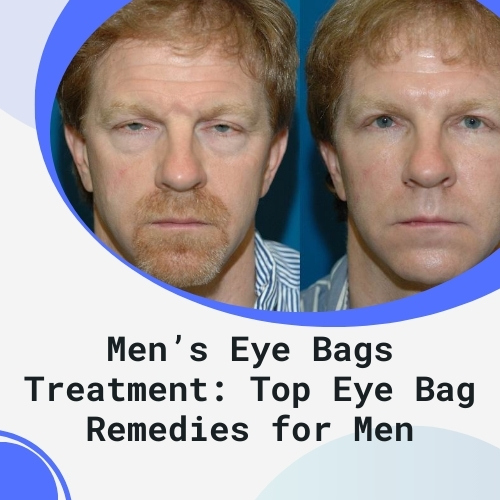 Men’s Eye Bags Treatment: Top Eye Bag Remedies for Men