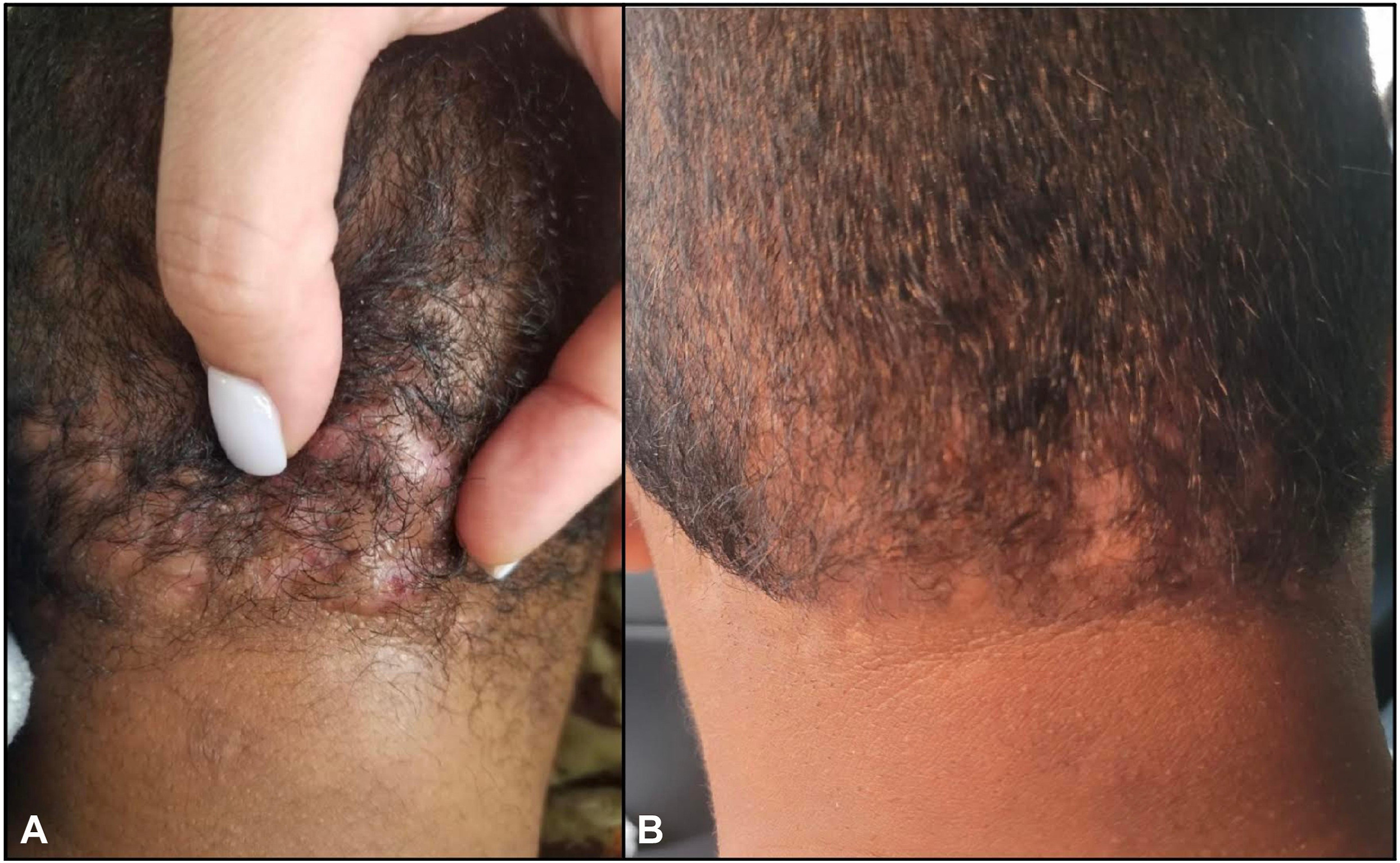 Folliculitis Keloidalis Nuchae Explained: Recognize, Treat, and Prevent It Now