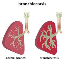 Bronchiectasis