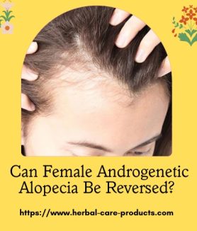 Female Androgenetic Alopecia