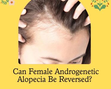 Female Androgenetic Alopecia