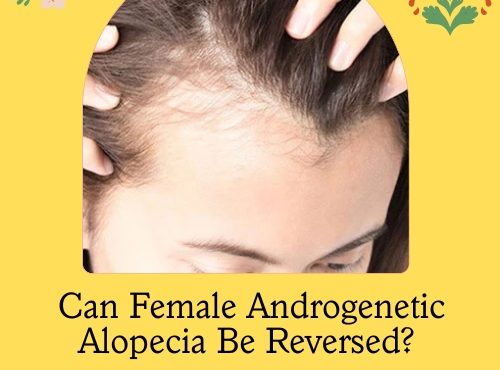 Female Androgenetic Alopecia