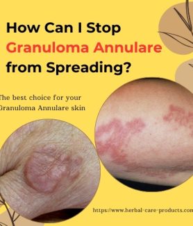 How Can I Stop Granuloma Annulare from Spreading 2