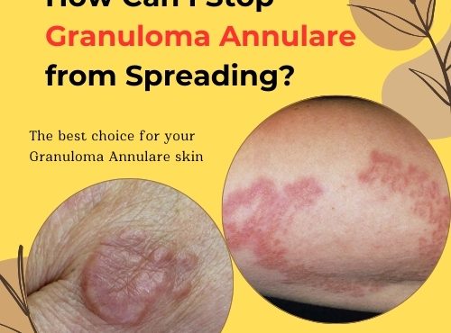 How Can I Stop Granuloma Annulare from Spreading 2