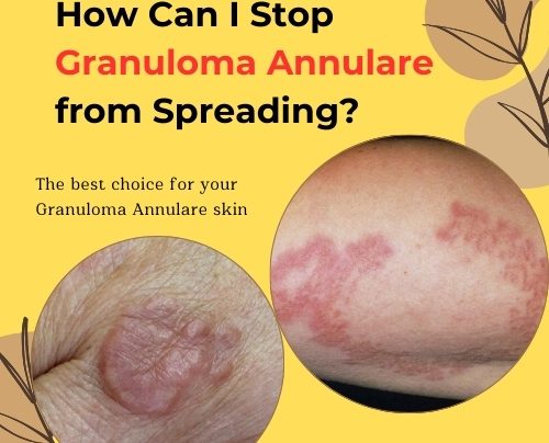 How Can I Stop Granuloma Annulare from Spreading 2