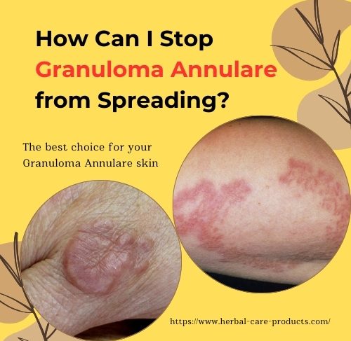 How Can I Stop Granuloma Annulare from Spreading 2