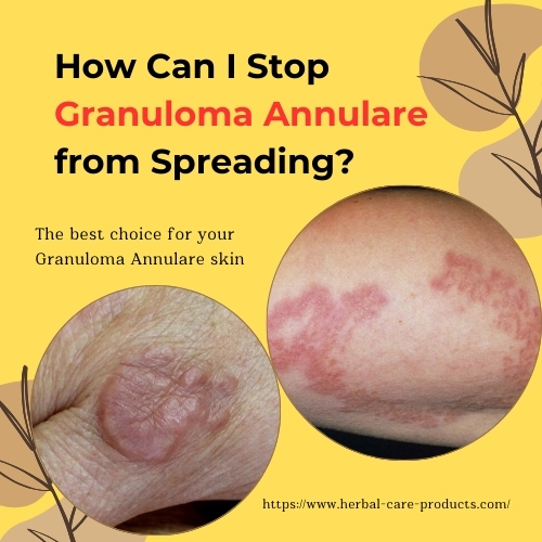 How Can I Stop Granuloma Annulare from Spreading?