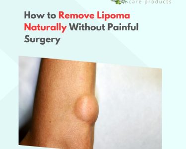 How to Remove Lipoma Naturally Without Painful Surgery