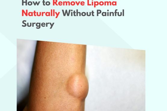 How to Remove Lipoma Naturally Without Painful Surgery