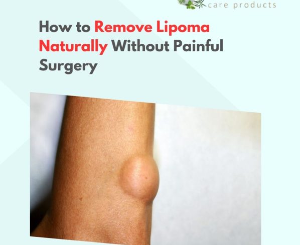 How to Remove Lipoma Naturally Without Painful Surgery