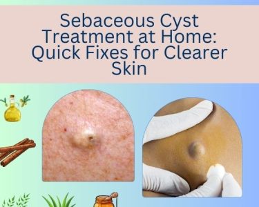 Sebaceous Cyst Treatment at Home 1