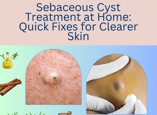 Sebaceous Cyst Treatment at Home 1