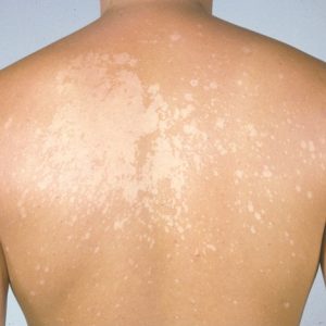 Treat Permanent Tinea Versicolor 2