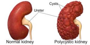 Polycystic Kidney Disease