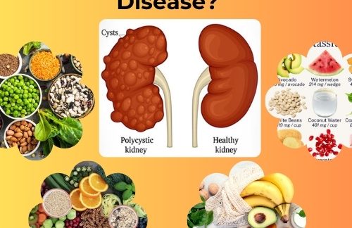 What Food Is Good for Polycystic Kidney Disease