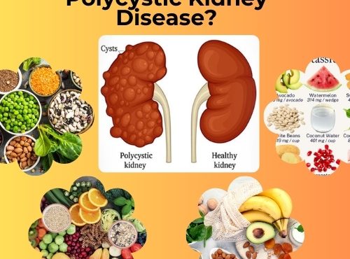 What Food Is Good for Polycystic Kidney Disease