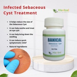 Infected Sebaceous Cyst Treatment