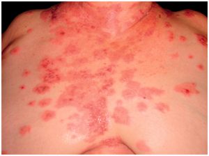 6 Effective Ways to Soothe Bullous Pemphigoid Blisters and Promote Healing